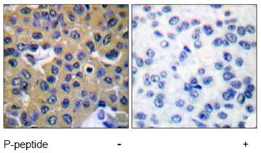 ab51174, at dilution of 1/50, staining SHP2 in paraffin embedded human breast carcinoma tissue by Immunohistochemistry. Left image: No peptide. Right image: Phosphopeptide present.