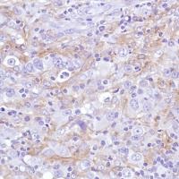 Immunohistochemical analysis of formalin fixed, paraffin embedded Human HK lymphoma tissue sections labeling Sialoadhesin using ab183356 at a 1/100 dilution.