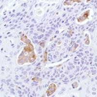 Immunohistochemical analysis of formalin fixed, paraffin embedded Human squamous cell cervical carcinoma tissue sections labeling Sialoadhesin using ab183356 at a 1/100 dilution.