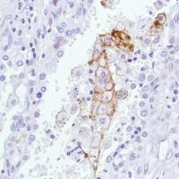 Immunohistochemical analysis of formalin fixed, paraffin embedded Human squamous cell lung carcinoma tissue sections labeling Sialoadhesin using ab183356 at a 1/100 dilution.