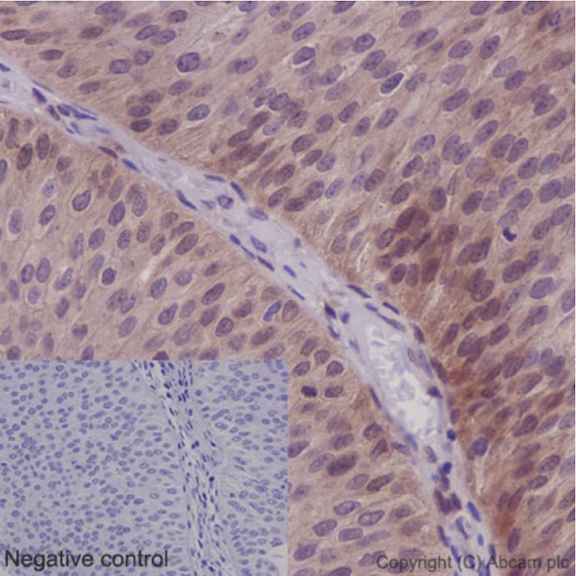 Immunohistochemical analysis of paraffin-embedded human transitional cell carcinoma of bladder tissue labeling NXN with ab191429 at 1/100 with prediluted HRP Polymer for Rabbit IgG as secondary antibody. Negative control: Using PBS instead of primary antibody.