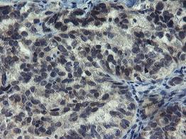 Immunohistochemical analysis of paraffin embedded Human ovary adenocarcinoma tissue labelling NYREN18 with ab131600 at 1/150 dilution.