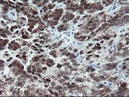 ab128096, at a dilution of 1/150, staining NYREN18 in paraffin-embedded Human ovary adenocarcinoma tissue by Immunohistochemistry.
