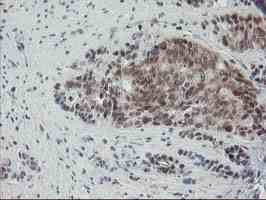 ab128096, at a dilution of 1/150, staining NYREN18 in paraffin-embedded Human pancreas carcinoma tissue by Immunohistochemistry.