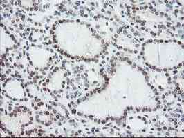 ab128096, at a dilution of 1/150, staining NYREN18 in paraffin-embedded Human thyroid carcinoma tissue by Immunohistochemistry.