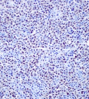 Immunohistochemical analysis of paraffin-embedded Human DLBCL tissue labeling Oct-2 with ab178679 at 1:100 dilution.