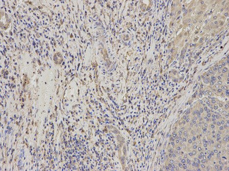 Immunohistochemistry (Formalin/PFA-fixed paraffin-embedded sections) analysis of human liver cancer tissue labelling Niemann Pick C2 with ab186829 at 1/200. Magnification: 200x.
