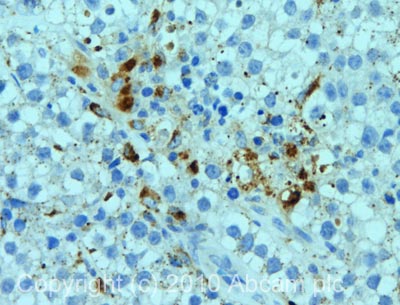 IHC image of Niemann Pick C2 staining in human testis seminoma formalin fixed paraffin embedded tissue section, performed on a Leica BondTM system using the standard protocol F. The section was pre-treated using heat mediated antigen retrieval with sodium citrate buffer (pH6, epitope retrieval solution 1) for 20 mins. The section was then incubated with 92736, 5µg/ml, for 15 mins at room temperature and detected using an HRP conjugated compact polymer system. DAB was used as the chromogen. The section was then counterstained with haematoxylin and mounted with DPX.