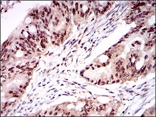 Immunohistochemical analysis of paraffin-embedded Human rectum cancer tissue labeling ONECUT3 with ab181450 at a 1/200 dilution.