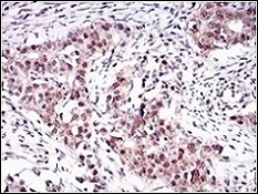 Immunohistochemical analysis of paraffin-embedded Human cervical cancer tissue labeling ONECUT3 with ab181450 at a 1/200 dilution.