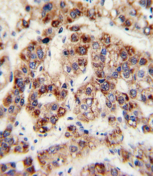 Immunohistochemical staining of formalin-fixed and paraffin-embedded human hepatoarcinoma with ab91418, followed by HRP-conjugated secondary antibody and DAB staining.