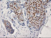 ab119067, at 1/150 dilution, staining OSGEP in paraffin-embedded Human breast adenocarcinoma tissue by Immunohistochemistry.