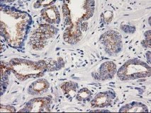 ab119067, at 1/150 dilution, staining OSGEP in paraffin-embedded Human prostate carcinoma tissue by Immunohistochemistry.
