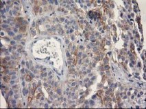 ab119067, at 1/150 dilution, staining OSGEP in paraffin-embedded Human bladder carcinoma tissue by Immunohistochemistry.