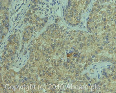 IHC image of Osteopontin staining in human breast carcinoma formalin fixed paraffin embedded tissue section, performed on a Leica BondTM system using the standard protocol F. The section was pre-treated using heat mediated antigen retrieval with sodium citrate buffer (pH6, epitope retrieval solution 1) for 20 mins. The section was then incubated with ab63856, 5µg/ml, for 15 mins at room temperature and detected using an HRP conjugated compact polymer system. DAB was used as the chromogen. The section was then counterstained with haematoxylin and mounted with DPX.