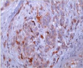 ab69498, at a 2µg/ml, staining human Osteopontin in Breast cancer, by Immunohistochemistry, Formalin fixed Paraffin embedded tissue. 