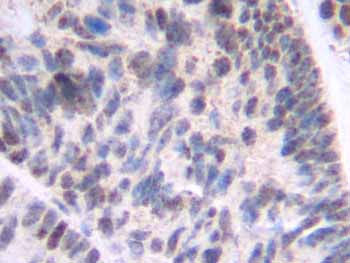 ab9986 at 0.5 µg/ml  staining human breast invasive ductal carcinoma by IHC-P. The antibody was incubated overnight incubation at 4˚C. An HRP-labeled polymer detection system was used with a DAB chromogen. Heat induced antigen retrieval with a pH 6.0 Sodium Citrate buffer is recommended. 