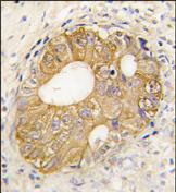 ab75718, at a dilution of 1/10, staining P cadherin in formalin fixed, paraffin embedded human prostate carcinoma tissue by Immunohistochemistry. ab75718 was peroxidase conjugated to the secondary antibody, followed by DAB staining.
