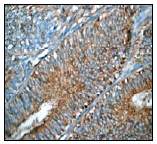 Ab51243 (1:50) staining human p16 ARC in human uterus adenocarcinoma by immunohistochemistry using paraffin embedded tissue.Ab51243 (1:50) staining human p16 ARC in human uterus adenocarcinoma by immunohistochemistry using paraffin embedded tissue.