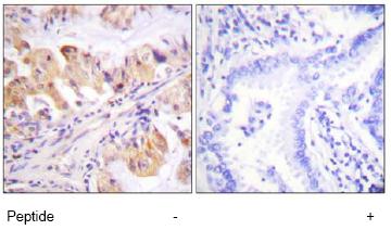 ab74111, at a 1/50 dilution, staining p23 in paraffin embedded human lung carcinoma tissue by Immunohistochemistry in the absence (left image) or presence (right image) of the immunising peptide.