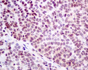 Immunohistochemical analysis of paraffin-embedded Human ovarian carcinoma tissue labeling p53R2 with ab154194 at 1/50 dilution.