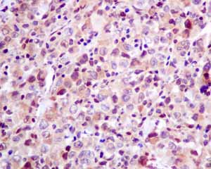 Immunohistochemical analysis of paraffin embedded Human melanoma tissue using ab154194 showing +ve staining.