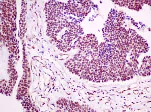 Immunohistochemical analysis of paraffin embedded Human urinary bladder transitional carcinoma tissue using ab154194 showing +ve staining.