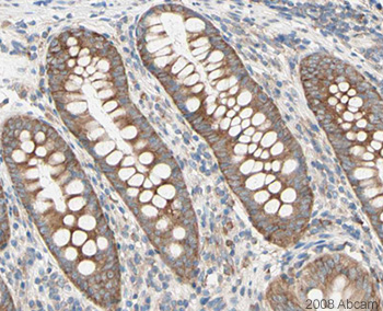 Image courtesy of Human Protein Atlasab21060 staining PABP in Human appendix. The paraffin embedded tissue was incubated with ab21060 (1/40 dilution) for 30 mins at room temperature. Antigen retrieval was performed by heat induction in citrate buffer pH 6. ab21060 was tested in a tissue microarray (TMA) containing a wide range of normal and cancer tissues as well as a cell microarray consisting of a range of commonly used, well characterised human cell lines. Further results for this antibody can be found at www.proteinatlas.org