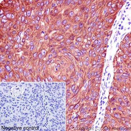 Immunohistochemical analysis of paraffin-embedded Human cervix carcinoma tissue labeling PACSIN3 with ab192875 at 1/1000 dilution followed by pre-diluted HRP Polymer for Rabbit/Mouse IgG secondary antibody. Counter stained with Hematoxylin.