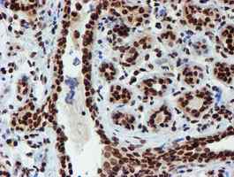 ab128086, at a dilution of 1/150, staining PADI4 / PAD4 in paraffin-embedded Human breast tissue by Immunohistochemistry.