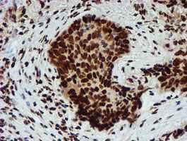 ab128086, at a dilution of 1/150, staining PADI4 / PAD4 in paraffin-embedded carcinoma of Human lung tissue by Immunohistochemistry.