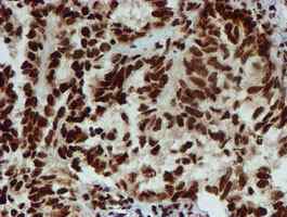 ab128086, at a dilution of 1/150, staining PADI4 / PAD4 in paraffin-embedded Adenocarcinoma of Human ovary tissue by Immunohistochemistry.