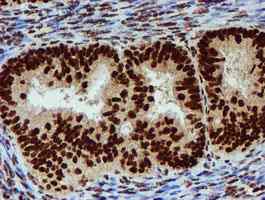 ab128086, at a dilution of 1/150, staining PADI4 / PAD4 in paraffin-embedded Adenocarcinoma of Human endometrium tissue by Immunohistochemistry.