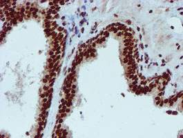 ab128086, at a dilution of 1/150, staining PADI4 / PAD4 in paraffin-embedded Carcinoma of Human prostate tissue by Immunohistochemistry.