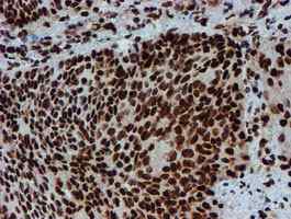 ab128086, at a dilution of 1/150, staining PADI4 / PAD4 in paraffin-embedded Carcinoma of Human bladder tissue by Immunohistochemistry.