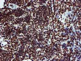 ab128086, at a dilution of 1/150, staining PADI4 / PAD4 in paraffin-embedded Human lymphoma tissue by Immunohistochemistry.