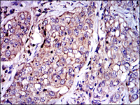 ab123687 at 1/200 dilution staining PAI1 in Paraffin-embedded Human lung cancer tissue by Immunohistochemistry followed by DAB staining.