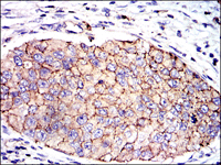 ab123687 at 1/200 dilution staining PAI1 in Paraffin-embedded Human kidney cancer tissue by Immunohistochemistry followed by DAB staining.