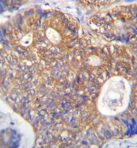 Immunohistochemistry analysis in formalin fixed and paraffin embedded Human colon carcinoma labeling PAICS using ab171381 at 1/10 dilution followed by peroxidase conjugation of the secondary antibody and DAB staining.