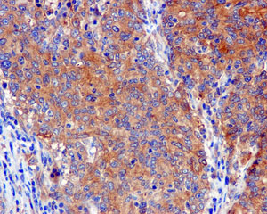 Immunohistochemical analysis of paraffin-embedded Human gastric carcinoma tissue labeling PAIP1 with ab181359 at 1/50 dilution.