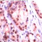 Ab41861 staining human Nkx3.1 in human prostrate by immunohistochemistry using formalin fixed, paraffin embedded tissue.