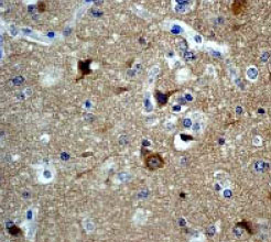 ab40808 at a 1:100 dilution staining PAK3 in human brain glioma.