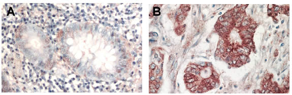 A: Normal colon tissue  B: Tumour tissue  Akt antibody (ab8805) used at 1/1000 on formalin-fixed paraffin embedded tissue.