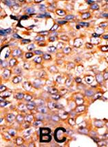 ab71455, at a 1/50 dilution, staining human PANK3 in breast carcinoma, using Immunohistochemistry, Formalin/PFA fixed Paraffin embedded tissue. ab71455 peroxidase-conjugated to a secondary antibody, followed by AEC staining