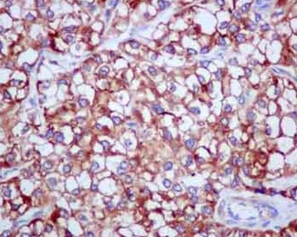 Immunohistochemical analysis of paraffin-embedded Human hepatocellualr carcinoma tissue labeling PAR2 with ab180953 at 1/100 dilution, followed by prediluted ImmunoHistoprobe (Ready to use) HRP Polymer for Rabbit IgG. Counter stained with Hematoxylin.