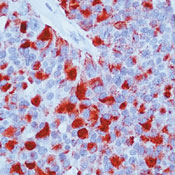 Formalin-fixed, paraffin-embedded human breast carcinoma stained with ab80704 at 4µg/ml using peroxidase-conjugate and AEC chromogen. Note cytoplasmic staining of tumor cells.