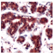 ab74268, at 1/50 dilution, staining DJ1 in formalin fixed, paraffin embedded human breast tissue by Immunohistochemistry.