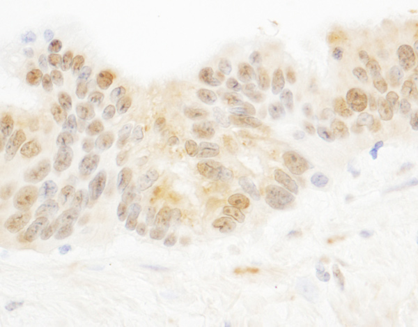 Immunohistochemistry (Formalin/PFA-fixed paraffin-embedded sections) analysis of human ovarian carcinoma tissue labelling PARP10 with ab70800 at 1/1000 (1µg/ml). Detection: DAB.
