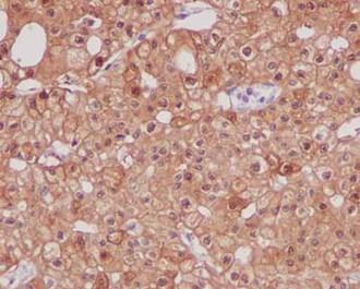 Immunohistochemical analysis of paraffin-embedded Human chromophobe carcinoma tissue labeling Parvalbumin with ab181086 at a 1/500 dilution.