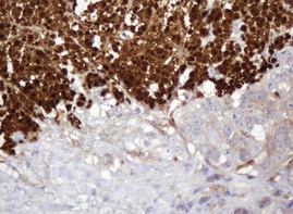 Immunohistochemical analysis of paraffin embedded Human colon adenocarcinoma tissue labelling PARVB with ab140384 at 1/150 dilution.
